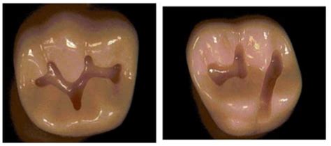 Cavity Preparation .